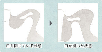 正常な場合の図