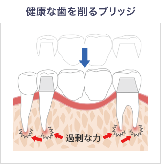 健康な歯を削るブリッジ