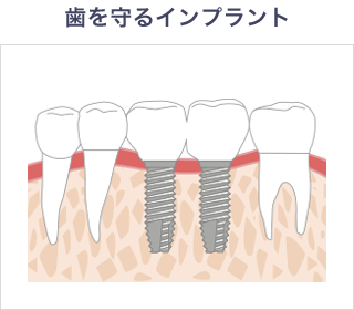 入れ歯のバネによる虫歯
