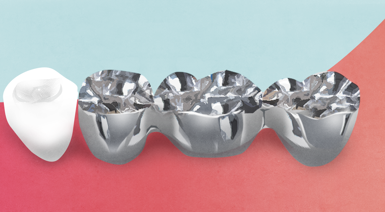 銀歯11g 当院で銀歯を用いた治療を行わない理由 - 院長ブログ - 藤沢市で