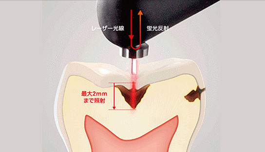 ダイアグノデント ペン 使用写真