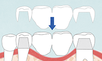 ブリッジとインプラントの違い