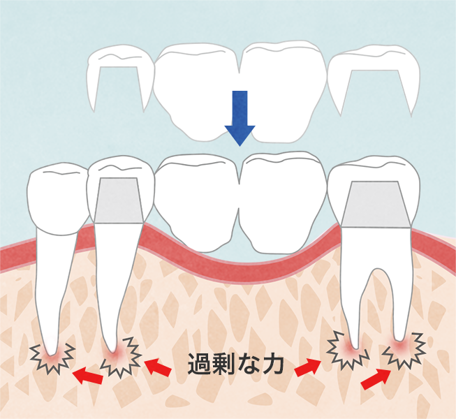 健康な歯を削るブリッジ