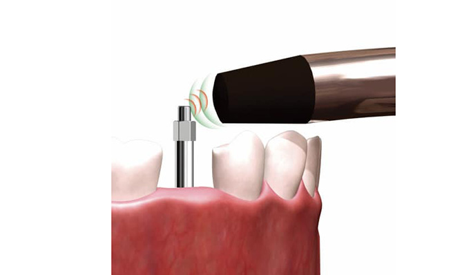 インプラント安定性モニター《MEGA ISQ》