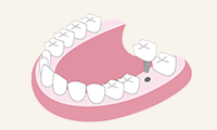 インプラント治療価格表