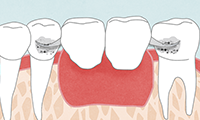ブリッジとインプラントの違い