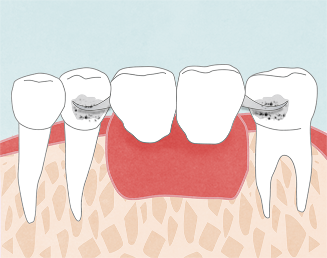 入れ歯のバネによる虫歯