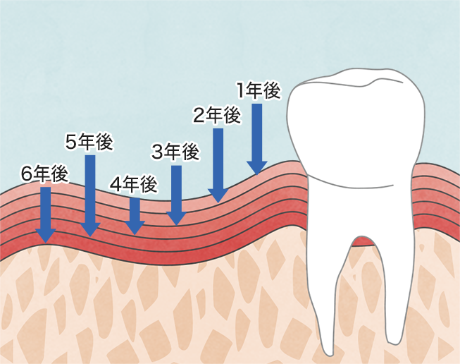 歯ぐきの吸収（年間0.5mm）