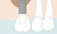 奥歯のインプラント