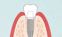奥歯のインプラント