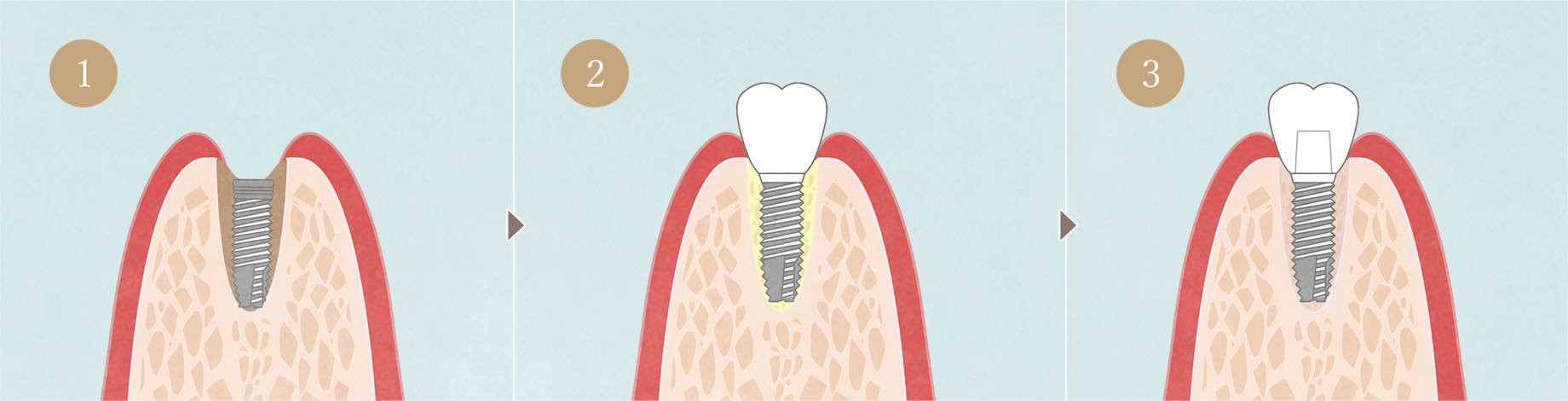 抜歯即時埋入インプラントの流れ