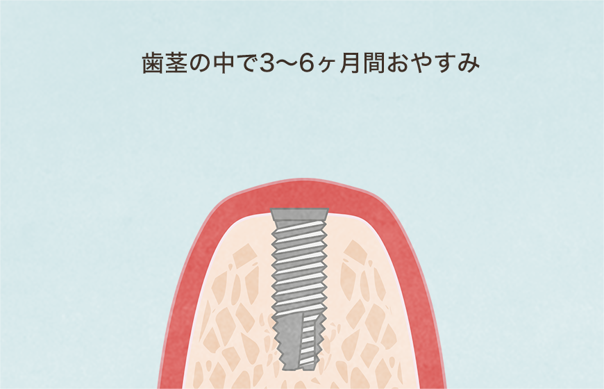 いままのでインプラント治療