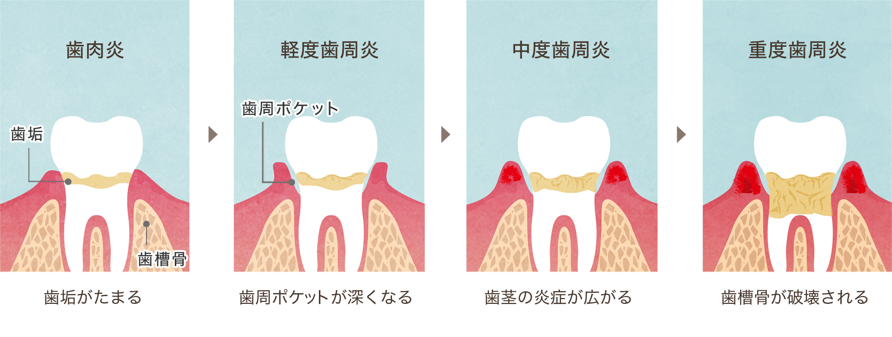 歯周病の進行イメージ