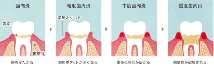 歯周病の進行イメージ