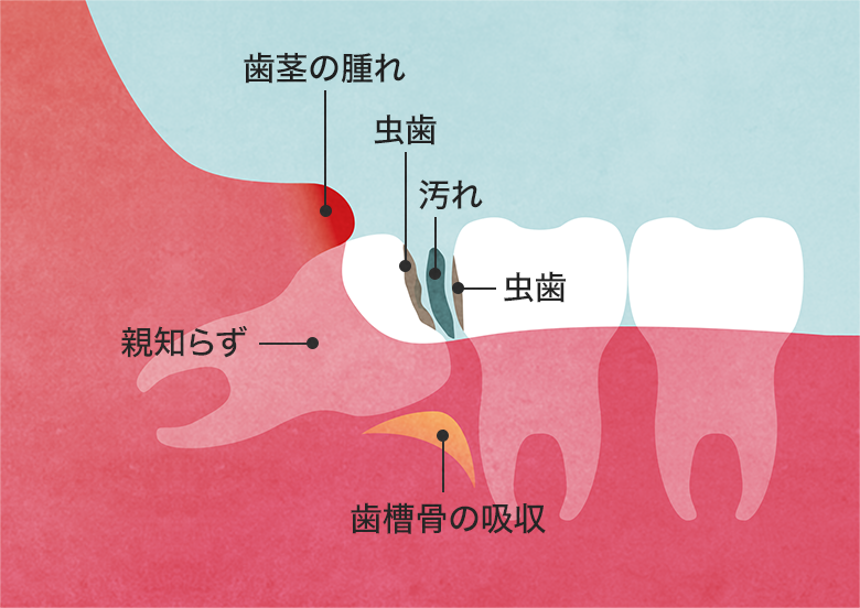 親知らず　むし歯、口臭、炎症・歯周病、隣の歯への影響図