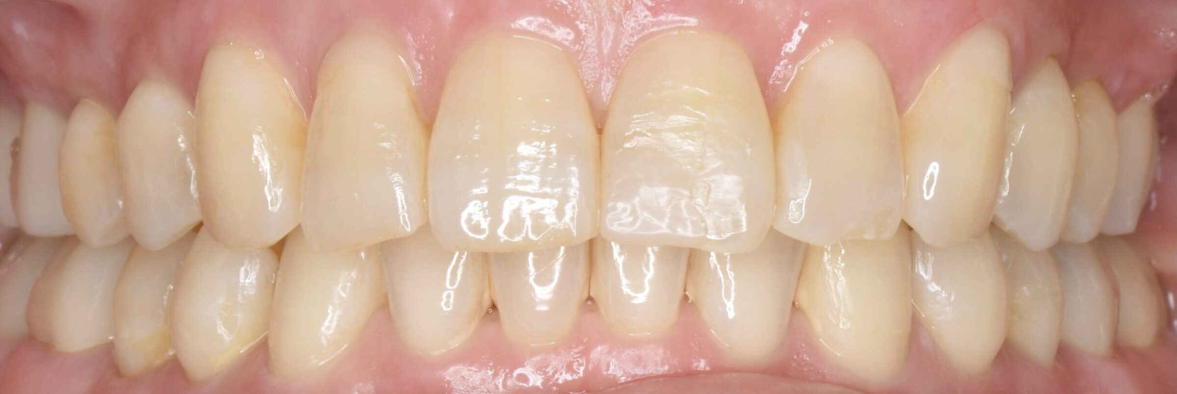 出っ歯を治したい方への矯正治療 院長ブログ くげぬま海岸歯科クリニック 審美 インプラント 矯正歯科 藤沢 鵠沼海岸 歯医者