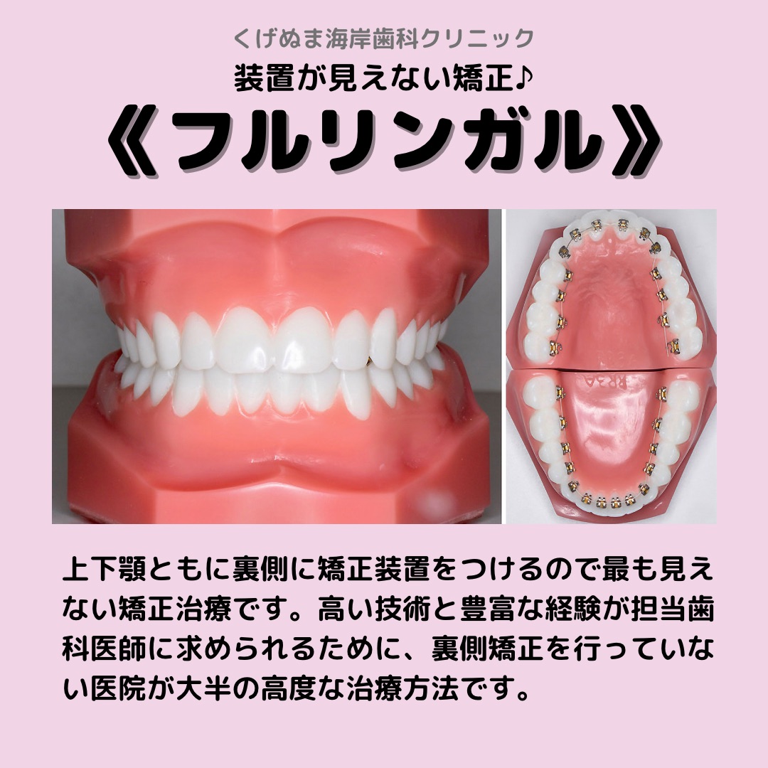 矯正の種類《フルリンガル》 - スタッフブログ - 藤沢市でインプラント