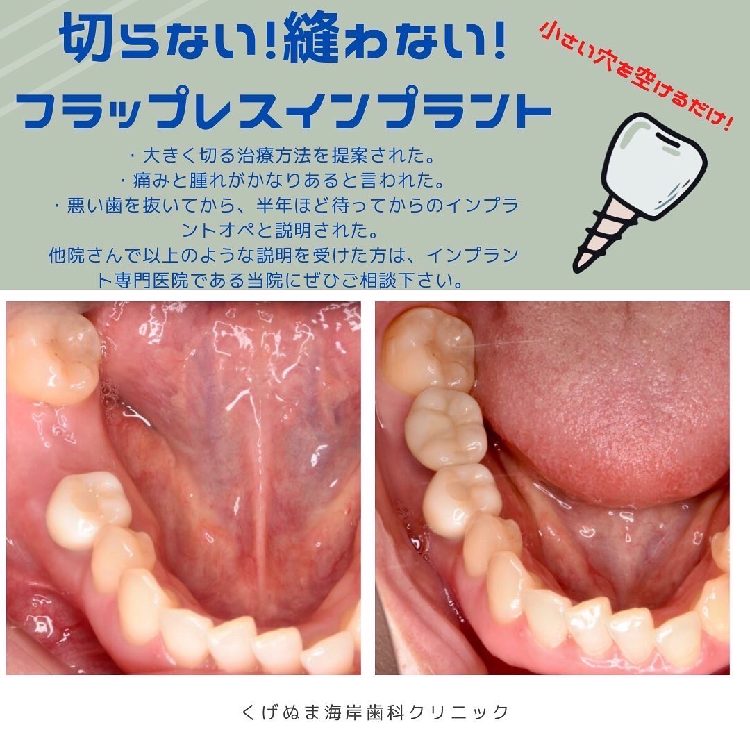 切らない！縫わない！フラップレスインプラントとは！ - スタッフ