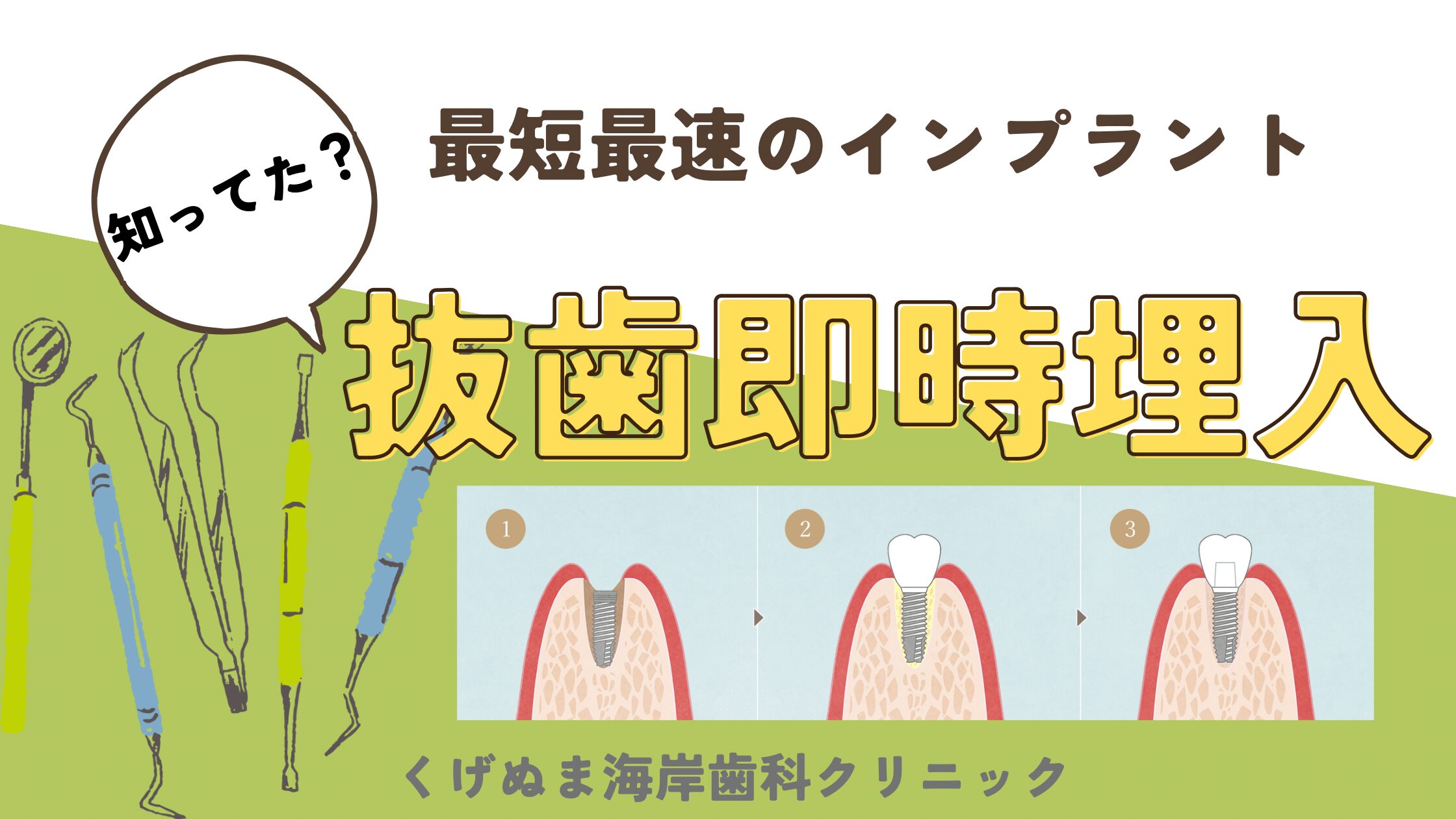 最短最速のインプラント術式『抜歯即時埋入』とは！！！ - スタッフ