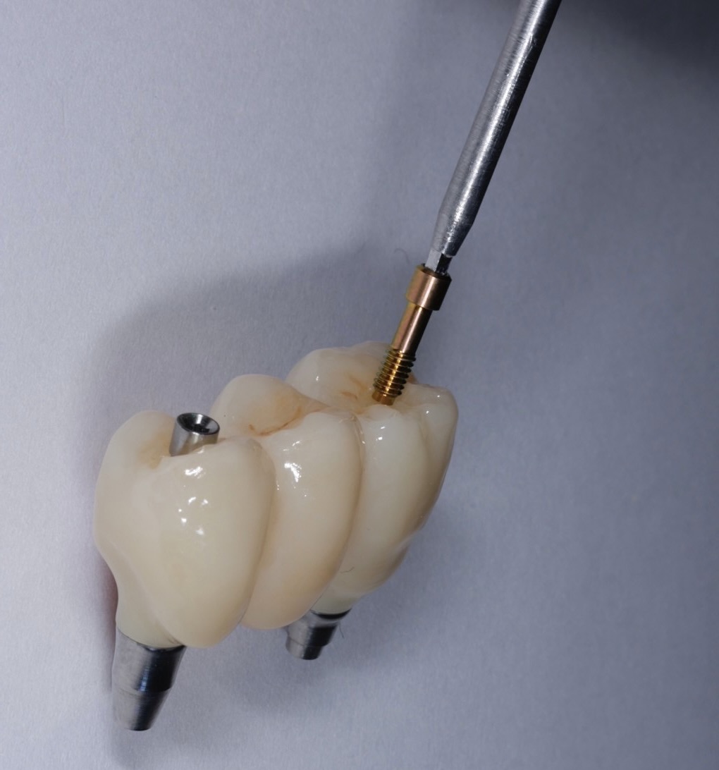 インプラントのスクリュー固定とは？ - 院長ブログ - 藤沢市で